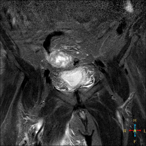 File:Cervical stump squamous cell carcinoma (Radiopaedia 48049-52858 G 1).jpg