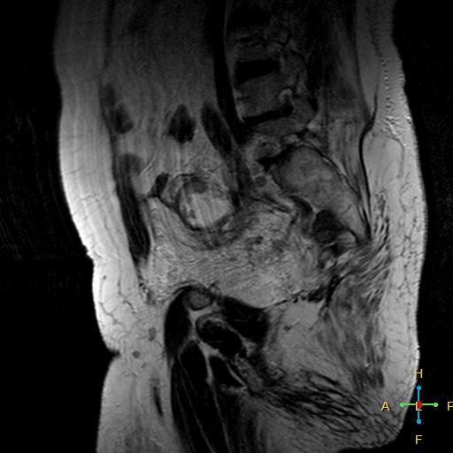 File:Cervical stump squamous cell carcinoma (Radiopaedia 48049-52858 Sagittal T2 14).jpg