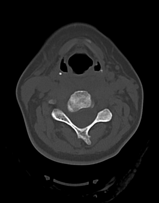 Cervical tuberculous spondylitis (Radiopaedia 39149-41365 Axial bone window 24).png
