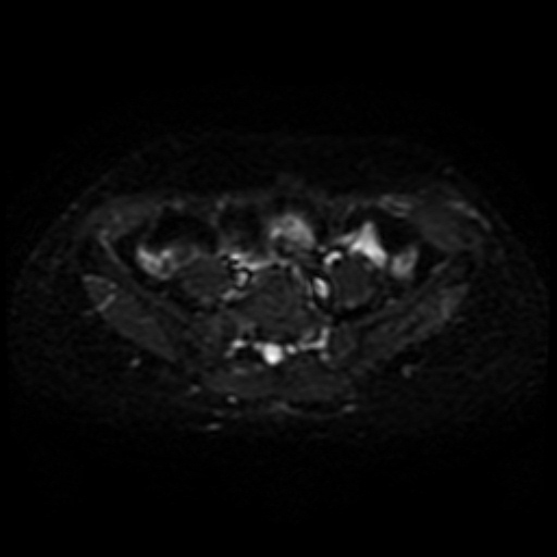 Cesarian section scar endometriosis (Radiopaedia 66520-75799 Axial DWI 2).jpg