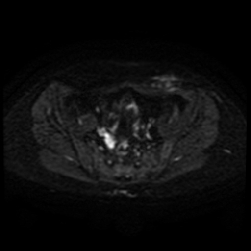 File:Cesarian section scar endometriosis (Radiopaedia 66520-75799 Axial DWI 32).jpg