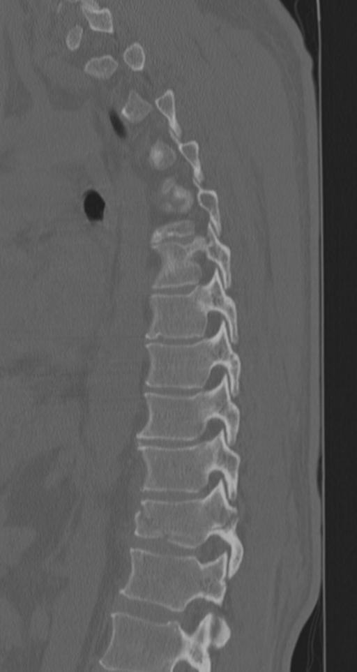 Chance fracture (Radiopaedia 33854-35020 Sagittal bone window 34).png
