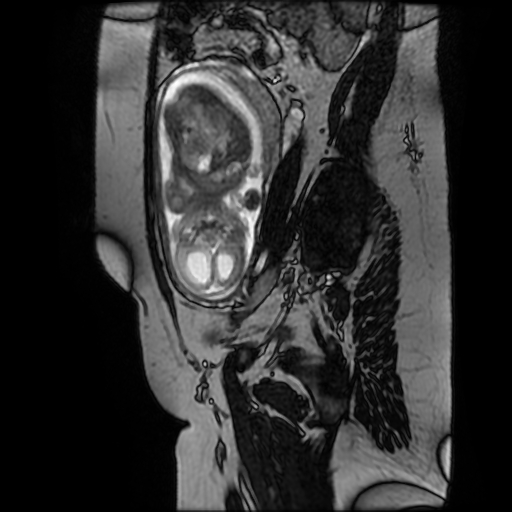 Chiari II malformation - fetal MRI (Radiopaedia 68099-77581 Sagittal Fiesta 16).jpg