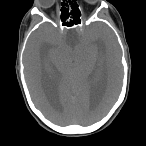 File:Chiari I malformation and obstructive hydrocephalus (Radiopaedia 41185-43981 D 16).png