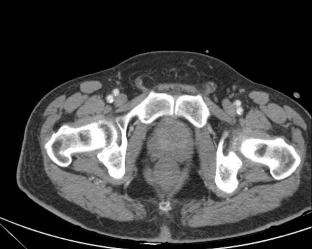 File:Cholecystitis - perforated gallbladder (Radiopaedia 57038-63916 A 81).jpg