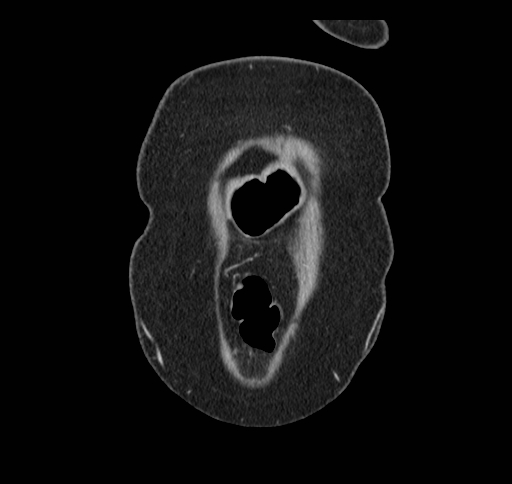 Cholecystoduodenal fistula (Radiopaedia 48959-54022 B 11).jpg