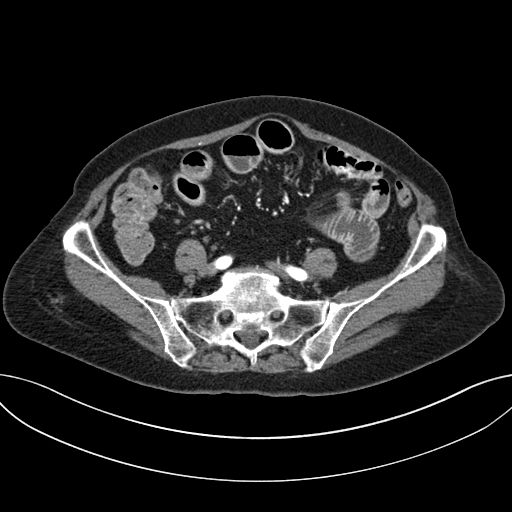 Cholecystoduodenal fistula due to calculous cholecystitis with gallstone migration (Radiopaedia 86875-103077 A 50).jpg