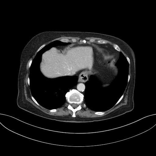 Cholecystoduodenal fistula due to calculous cholecystitis with gallstone migration (Radiopaedia 86875-103077 D 16).jpg
