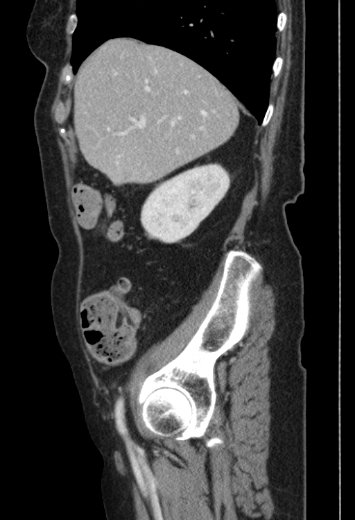 Cholecystoduodenal fistula due to calculous cholecystitis with gallstone migration (Radiopaedia 86875-103077 F 45).jpg