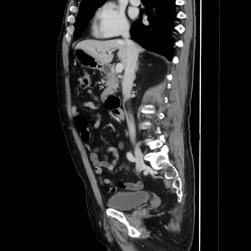 Choledocholiathiasis with normal caliber common bile duct (Radiopaedia 75368-86632 D 73).jpg