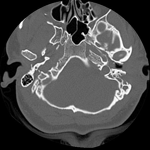 Cholesteatoma (Radiopaedia 84960-100474 Axial bone window 52).jpg