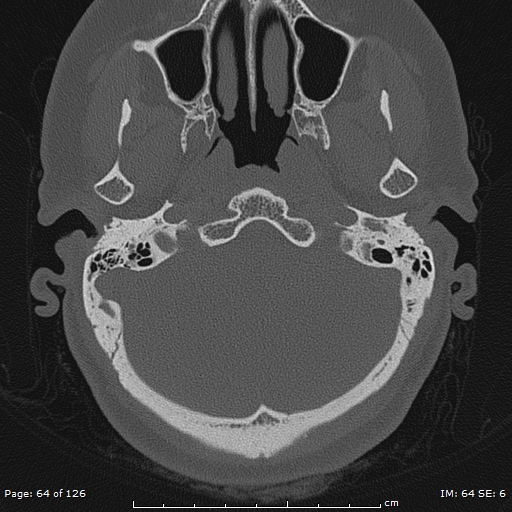 Cholesteatoma - external auditory canal (Radiopaedia 88452-105096 Axial bone window 27).jpg