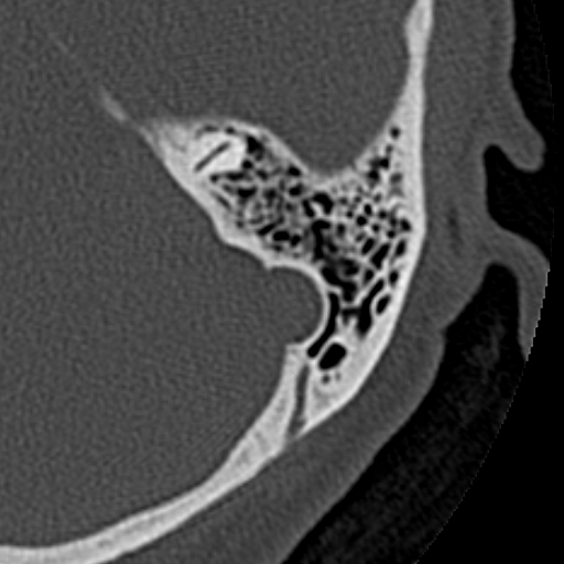 File:Cholesteatoma of the external ear (Radiopaedia 16540-16225 Axial bone window 11).jpg