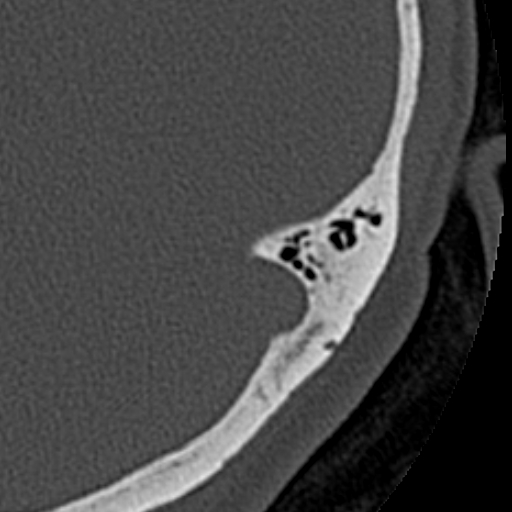 File:Cholesteatoma of the external ear (Radiopaedia 16540-16225 Axial bone window 3).jpg
