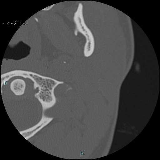 Cholesterol granuloma of the petrous apex (Radiopaedia 64358-73141 Axial bone window 101).jpg