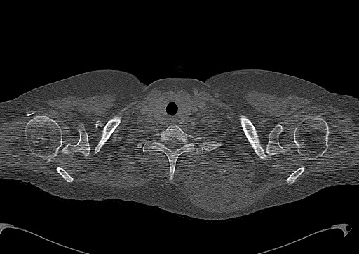 Chondrosarcoma - chest wall (Radiopaedia 65192-74199 Axial bone window 8).jpg