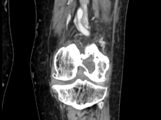 Chondrosarcoma - femur (Radiopaedia 64187-72954 C 36).jpg