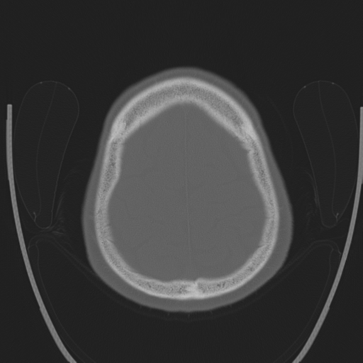 Chondrosarcoma of skull base- grade II (Radiopaedia 40948-43653 Axial bone window 42).png