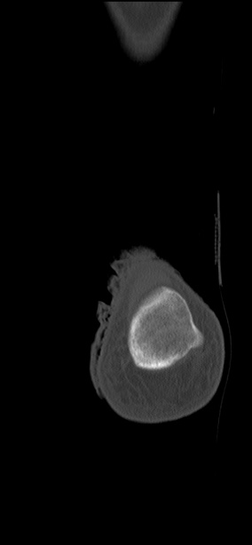 Chopart fracture (Radiopaedia 35347-36851 Coronal bone window 5).jpg