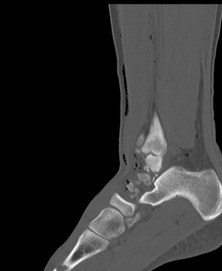 Chopart fracture (Radiopaedia 35347-36851 Sagittal bone window 40).jpg
