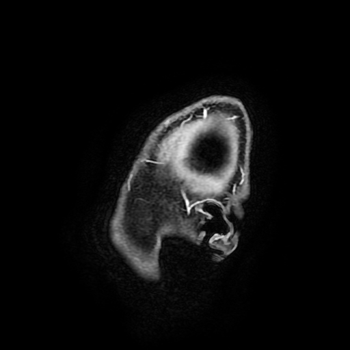 Chordoid glioma of third ventricle (Radiopaedia 91612-109340 F 16).jpg