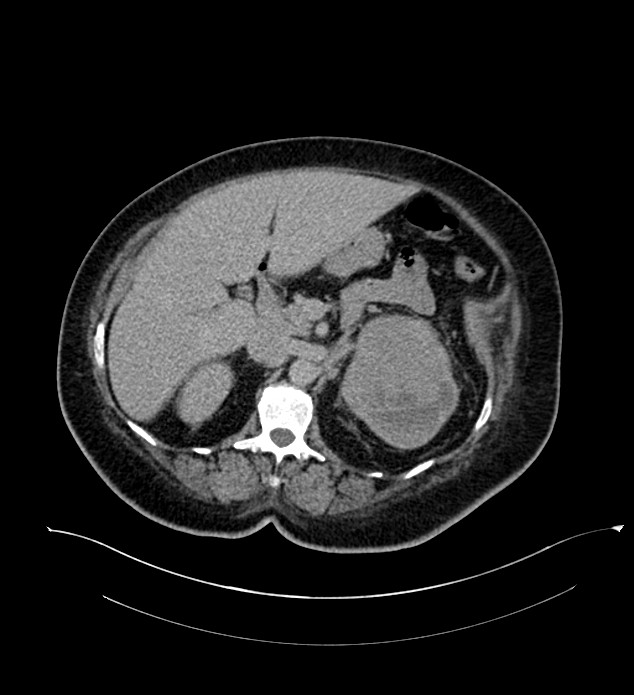 Chromophobe renal cell carcinoma (Radiopaedia 84239-99519 E 64).jpg
