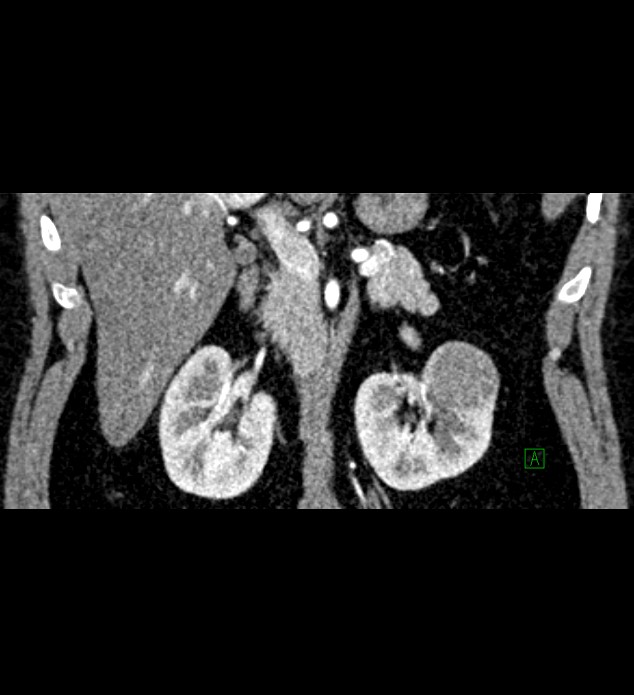 Chromophobe renal cell carcinoma (Radiopaedia 84286-99573 E 31).jpg