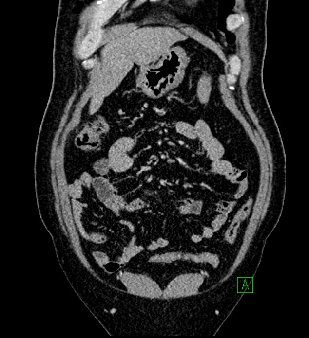 Chromophobe renal cell carcinoma (Radiopaedia 84286-99573 H 42).jpg