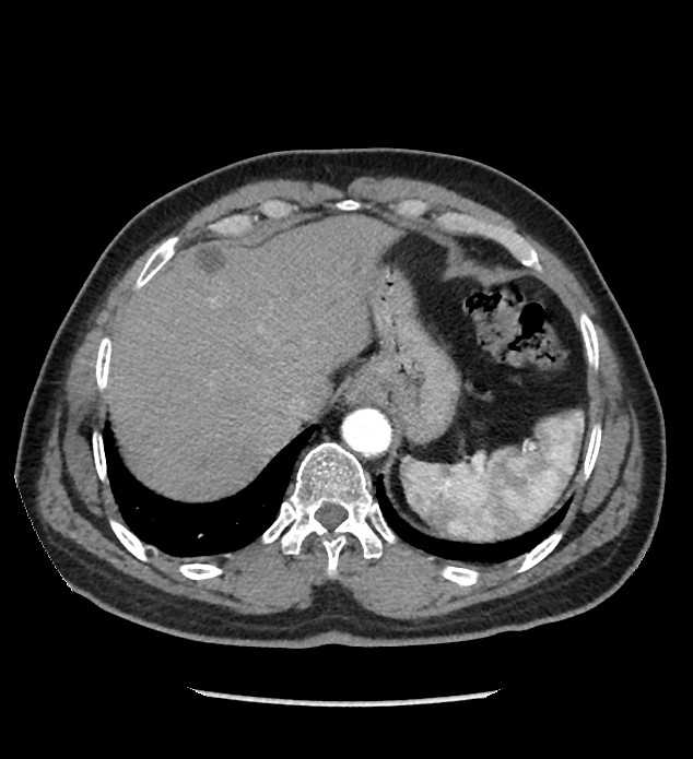 Chromophobe renal cell carcinoma (Radiopaedia 86879-103083 B 26).jpg