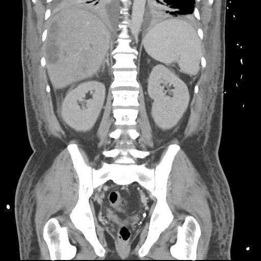 Chronic diverticulitis complicated by hepatic abscess and portal vein thrombosis (Radiopaedia 30301-30938 B 41).jpg