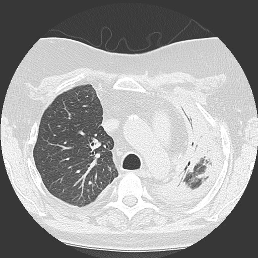 Chronic lung allograft dysfunction - restrictive form (Radiopaedia 60595-68316 Axial lung window 21).jpg
