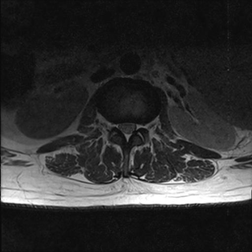 File:Chronic myeloid leukemia (MRI) (Radiopaedia 56128-62777 Axial T2 11).jpg