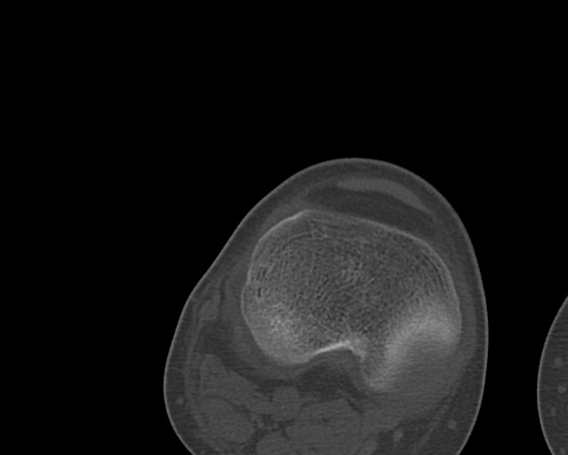 Chronic ostemyelitis of the femur with long sinus tract (Radiopaedia 74947-85982 Axial bone window 233).jpg