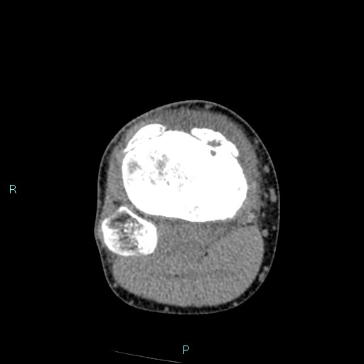 Chronic osteomyelitis (with Brodie abscess) (Radiopaedia 76405-88111 A 85).jpg