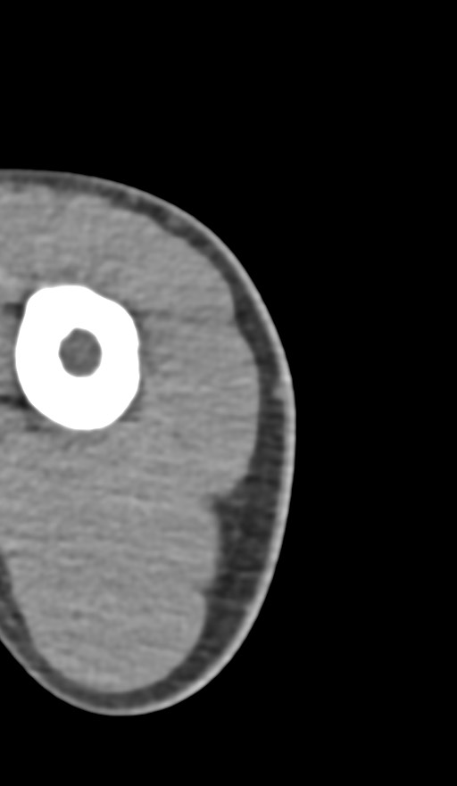 Chronic osteomyelitis of the distal humerus (Radiopaedia 78351-90971 Axial non-contrast 2).jpg