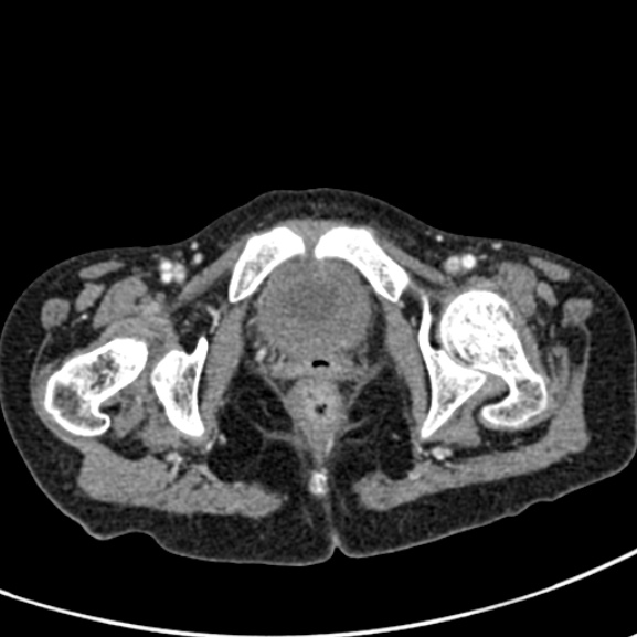 File:Chronic pancreatitis (Radiopaedia 55405-61846 A 106).jpg