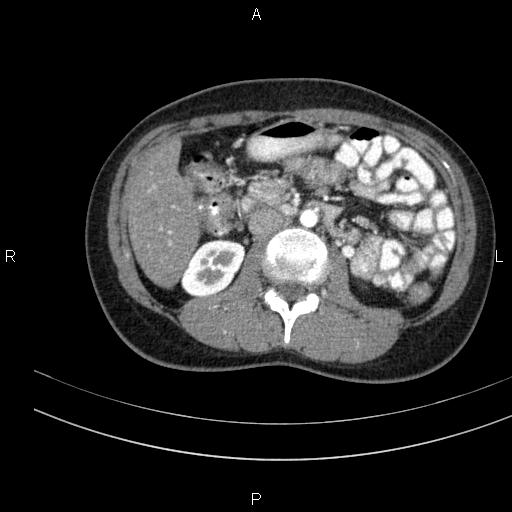 Chronic pancreatitis (Radiopaedia 64576-73450 B 75).jpg