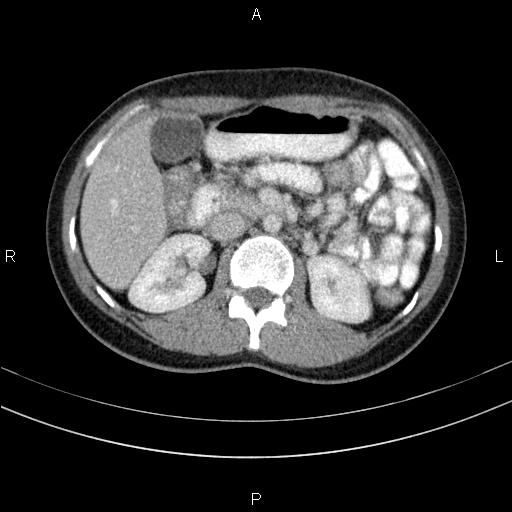 Chronic pancreatitis (Radiopaedia 64576-73450 C 63).jpg