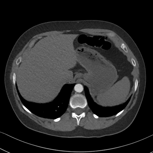 File:Chronic pulmonary embolus (Radiopaedia 39129-41341 Axial C+ CTPA 90).png