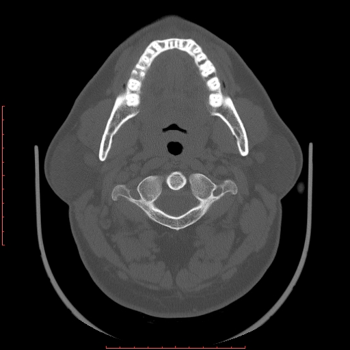 Chronic submandibular sialolithiasis (Radiopaedia 69817-79814 Axial bone window 39).jpg