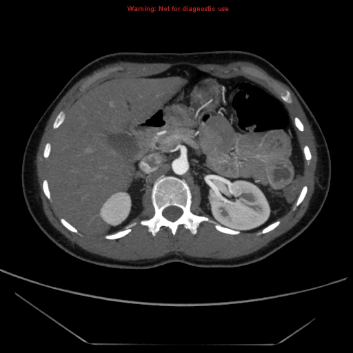 File:Circumaortic left renal vein (Radiopaedia 9069-9792 A 11).jpg
