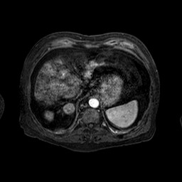 Cirrhosis and hepatocellular carcinoma in the setting of hemochromatosis (Radiopaedia 75394-86594 Axial T1 C+ fat sat 143).jpg