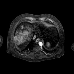 Cirrhosis and hepatocellular carcinoma in the setting of hemochromatosis (Radiopaedia 75394-86594 Axial T1 C+ fat sat 154).jpg