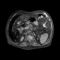 Cirrhosis and hepatocellular carcinoma in the setting of hemochromatosis (Radiopaedia 75394-86594 Axial T1 C+ fat sat 41).jpg