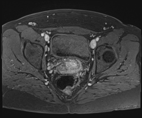 File:Class II Mullerian duct anomaly- unicornuate uterus with rudimentary horn and non-communicating cavity (Radiopaedia 39441-41755 Axial T1 fat sat 85).jpg