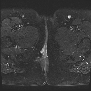 File:Class II Mullerian duct anomaly- unicornuate uterus with rudimentary horn and non-communicating cavity (Radiopaedia 39441-41755 Axial T2 fat sat 32).jpg