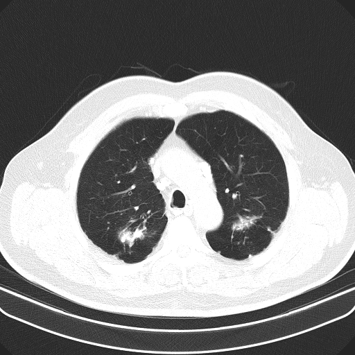 File:Classic complicated silicosis (Radiopaedia 49720-54961 Axial lung window 15).jpg