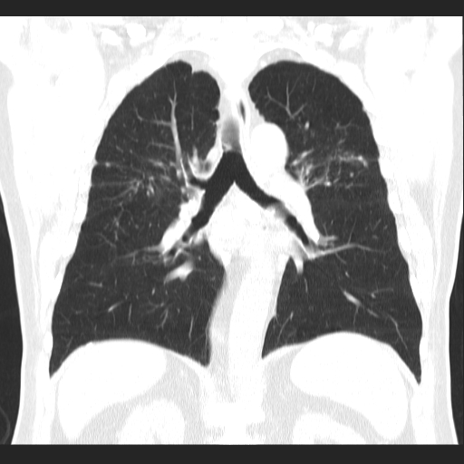 File:Classic complicated silicosis (Radiopaedia 49720-54961 Coronal lung window 38).jpg
