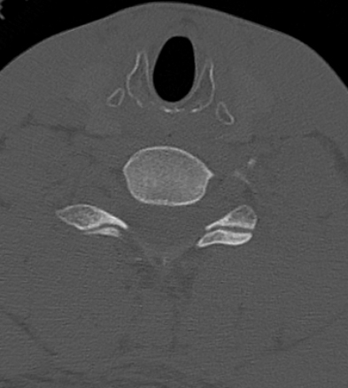 Clay-shoveler fracture (Radiopaedia 14604-14532 Axial bone window 14).jpg