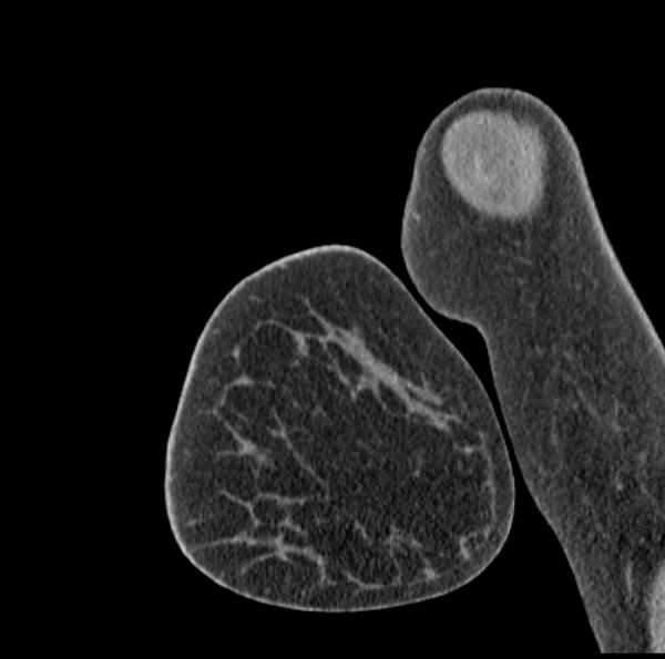 File:Clear cell chondrosarcoma - humerus (Radiopaedia 63104-71612 D 5).jpg